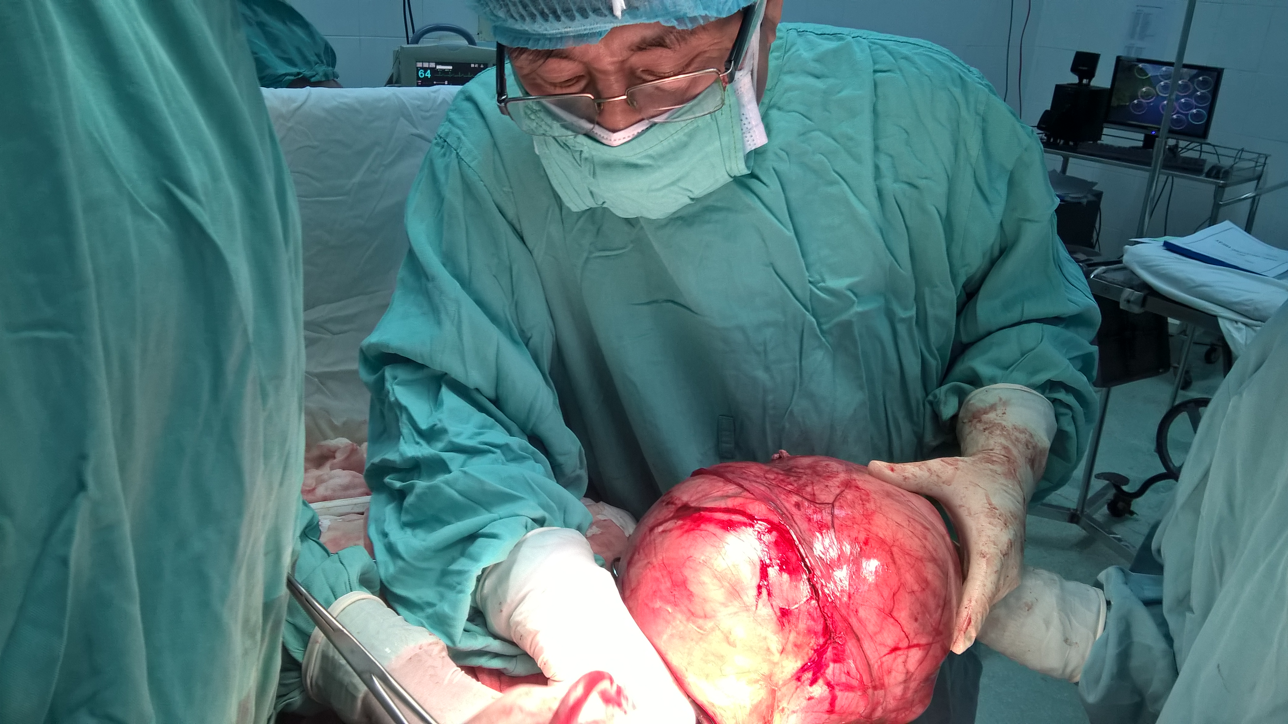 lay khoi u xo hon 5kg ra khoi co the nguoi phu nu 53 tuoi