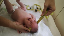 Quy trình tầm soát tật đầu nhỏ cho trẻ nghi ngờ nhiễm virus Zika