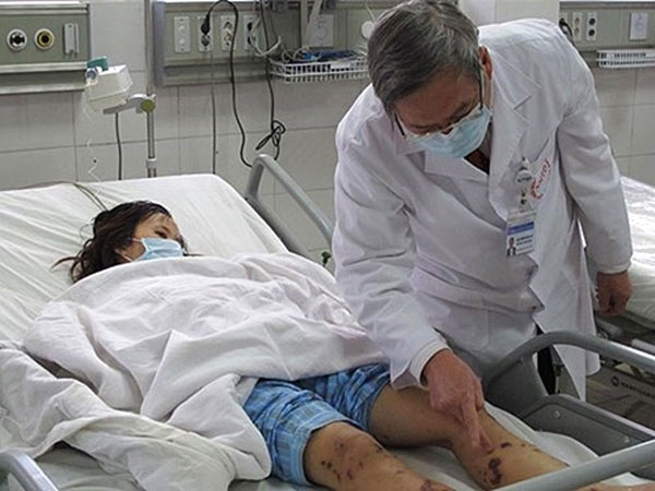 o benh viem nao mo cau duoc ha noi khong che the nao