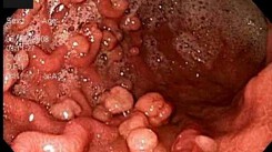 Mang bệnh này, 100% người sẽ bị ung thư sau tuổi 40