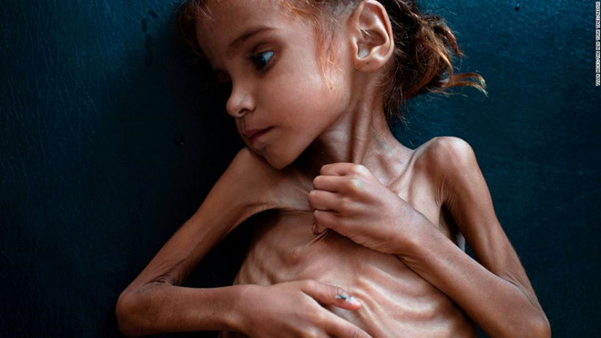 be gai da boc xuong gay chan dong the gioi ve nan doi o yemen qua doi