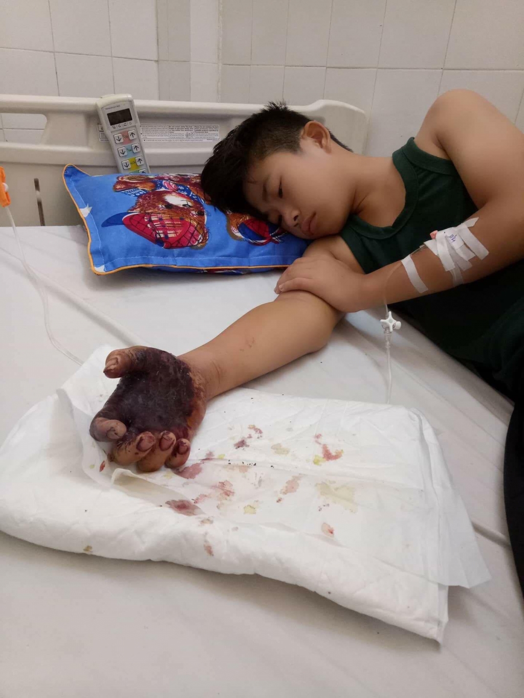 Xót xa cảnh người cha đơn thân nghèo nhìn con đau đớn bởi vết rắn độc cắn khi đang hái điều phụ gia đình xot xa hoan canh cua cau be lop 8 bi ran doc can