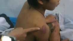 Trốn đi chơi, bé 11 tuổi bị bố ruột đánh đa chấn thương