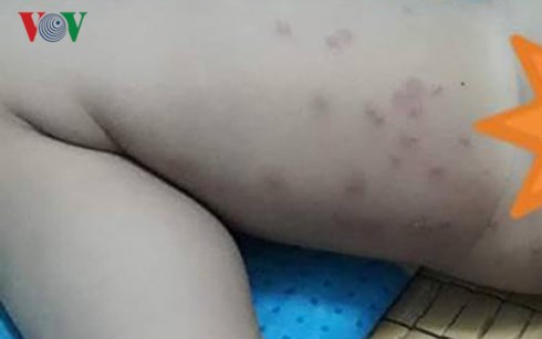 du khach tam bien da nang bi ngua ngay noi man do khap nguoi