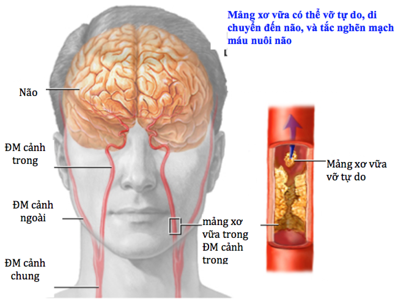 thieu mau nao cuc bo thoang qua va dot quy