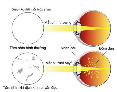 bong dung co ruoi bay truoc mat nguy hiem the nao