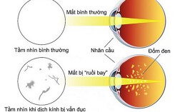 Bỗng dưng có “ruồi bay” trước mắt: Nguy hiểm thế nào?
