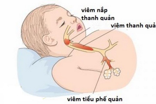 phong ngua viem tieu phe quan o tre em