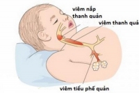 viem thanh khi phe quan cap o tre em la benh gi