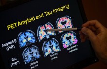 Có thể 'trị' bệnh Alzheimer mà không cần đến thuốc