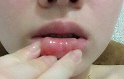 Cô gái không dám cười sau khi tiêm filler tạo hình môi trái tim