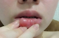 9 diem quan trong ban can biet truoc khi tiem botox