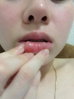co gai mu mat khi tiem filler spa dinh nhieu sai pham