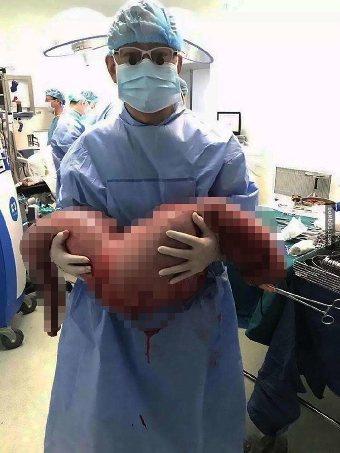 bac si loi ra quai vat nang 13 kg tu bung chang trai bi benh tao bon suot 20 nam
