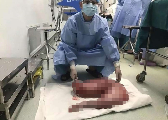 bac si loi ra quai vat nang 13 kg tu bung chang trai bi benh tao bon suot 20 nam