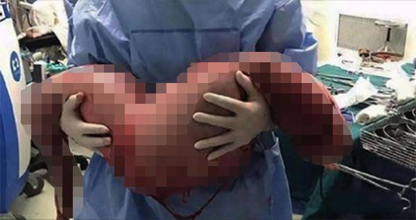 bac si loi ra quai vat nang 13 kg tu bung chang trai bi benh tao bon suot 20 nam