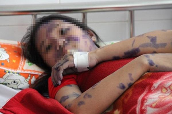 co gai tre nguy kich vi bien chung khong ngo cua benh thuy dau