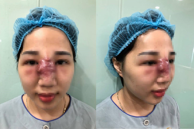 mui mung mu sau khi tiem filler tai spa