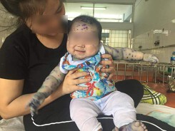 TP.HCM: Mẹ không tiêm phòng trước sinh, nhiều trẻ dưới 3 tháng nhập viện vì mắc thủy đậu