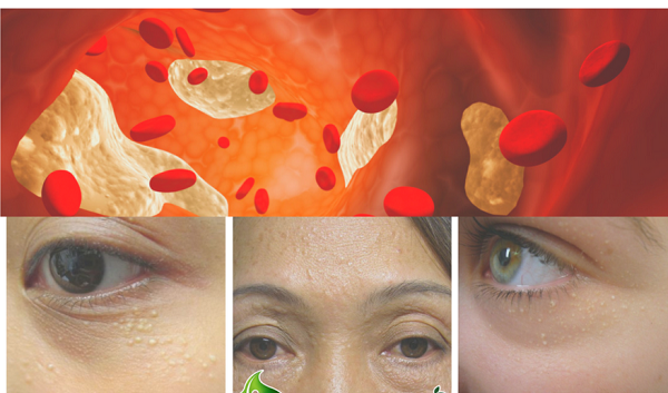 xu ly va phong ngua cholesterol tich tu quanh mat
