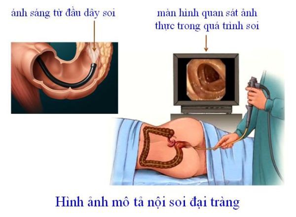cach phat hien som ung thu dai trang