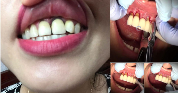 gap hoa vi rang su tham my