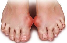 Người bệnh gout nên ăn những loại thực phẩm này