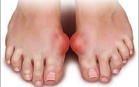 tai sao nguoi benh gout so bia hon ruou