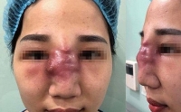 co gai mu mat khi tiem filler spa dinh nhieu sai pham