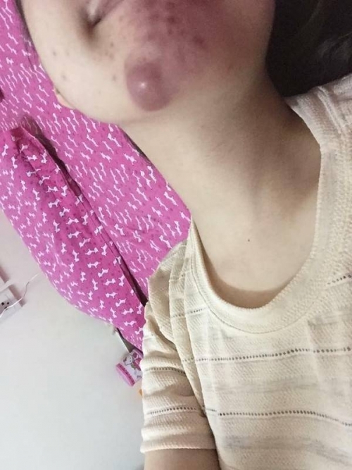 sau hang loat phot ve tiem filler dau la cuu canh cho phuong phap lam dep nay
