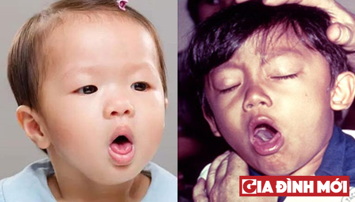bac si nhi giup nhan dien phan biet cac chung ho pho bien o tre