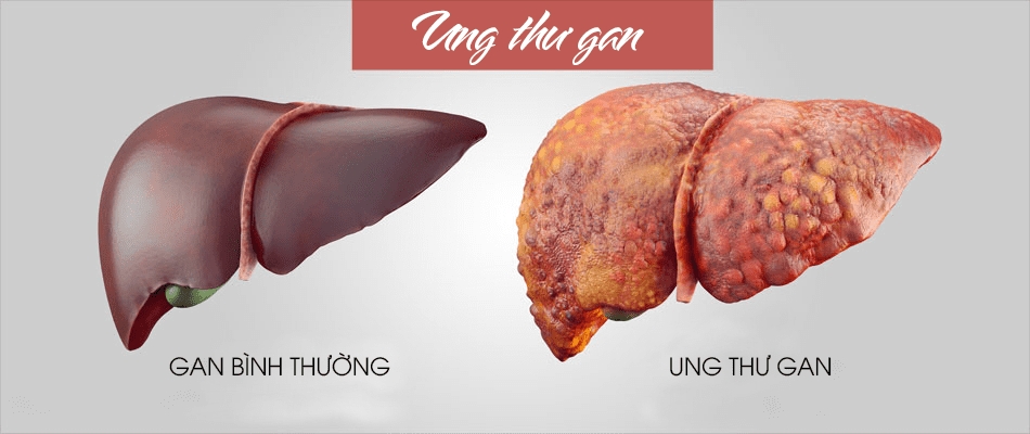 moi ngay viet nam co hon 300 nguoi chet vi ung thu