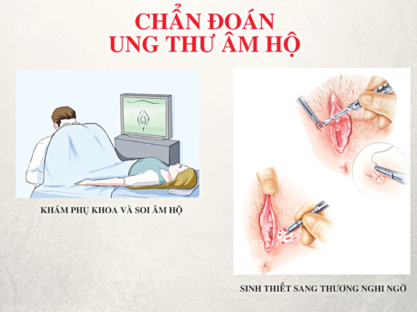 ung thu am ho nhung dieu can biet
