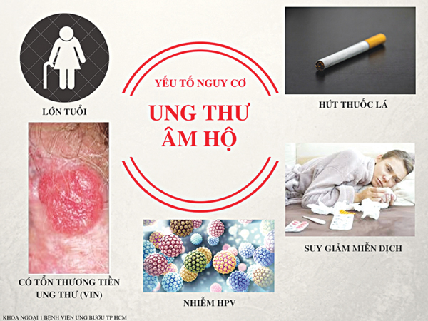 ung thu am ho nhung dieu can biet
