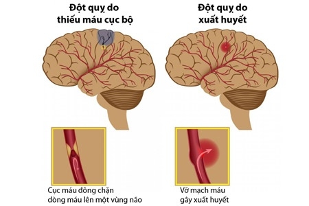 nguoi gia can canh giac voi nguy co dot quy mua nang nong