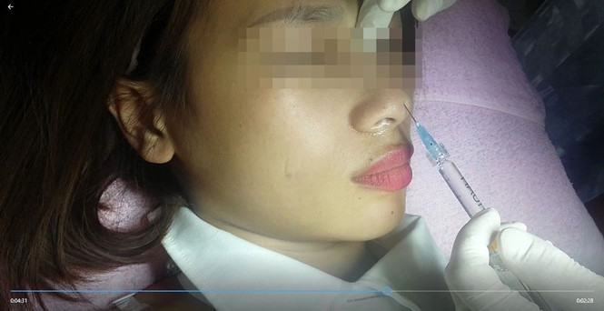 vu tiem filler vao mui gay mu mat boi thuong 350 trieu dong