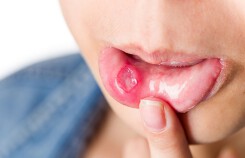 Viêm loét miệng, khi nào cần đi khám?