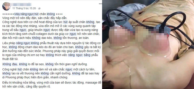 nang nguc bang may hut chan khong tro lua bip cua cac co so lam dep