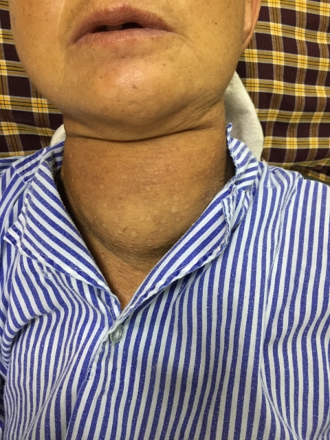 giai thoat cho benh nhan 30 nam deo khoi buou giap khong lo