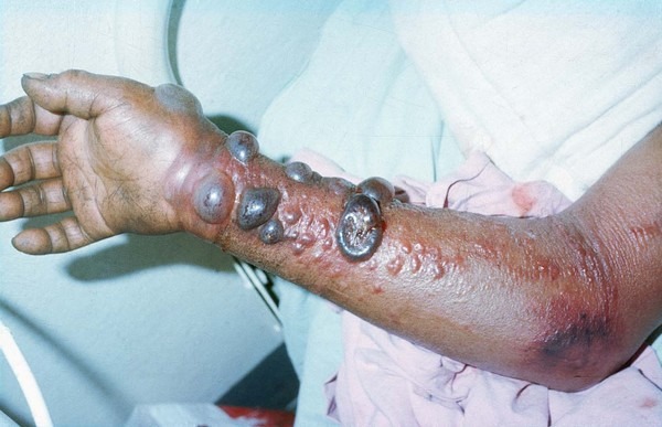them 27 nguoi chet vi virus ebola viet nam giam sat chat cua khau ngan dich chet nguoi