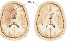 U não thường phát hiện muộn