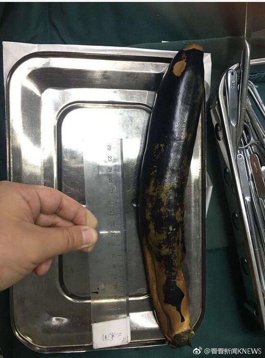 nguoi dan ong nhet ca tim 30 cm vao hau mon de tri tao bon