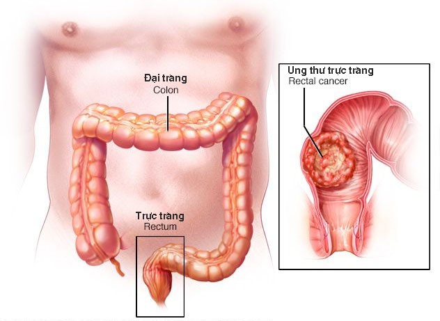 an bun pho dua chua thuc pham bi moc co the bi ung thu gi
