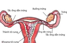 Những bệnh lý ở buồng trứng gây hiếm muộn