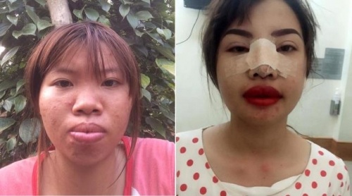 quy ong yeu hon hay chay mat dep truoc nguoi yeu tu vit hoa thien nga sau phau thuat tham my