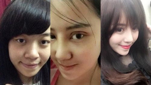 xon xao thieu phu phau thuat tham my de giu chong
