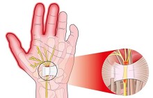 Những cách giảm đau tay tự nhiên và dễ thực hiện nhất