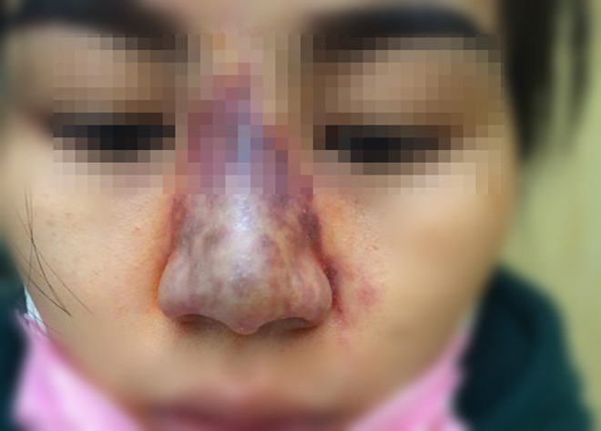 co gai suyt mat mui vi tiem filler trung tinh mach