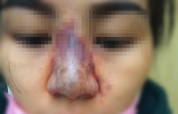 mui mung mu sau khi tiem filler tai spa