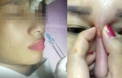 Tại sao nâng mũi, độn cằm bằng filler có thể gây biến chứng